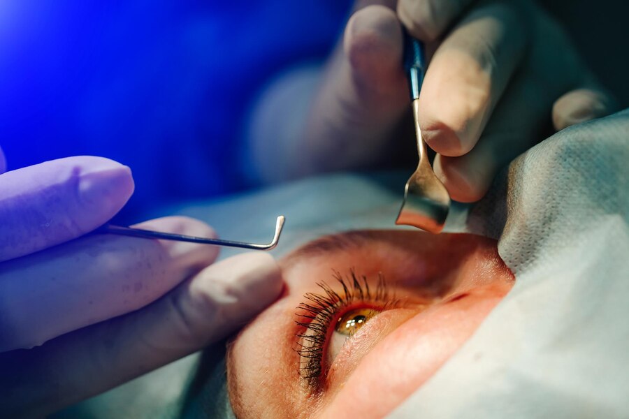 laser eye surgery cost